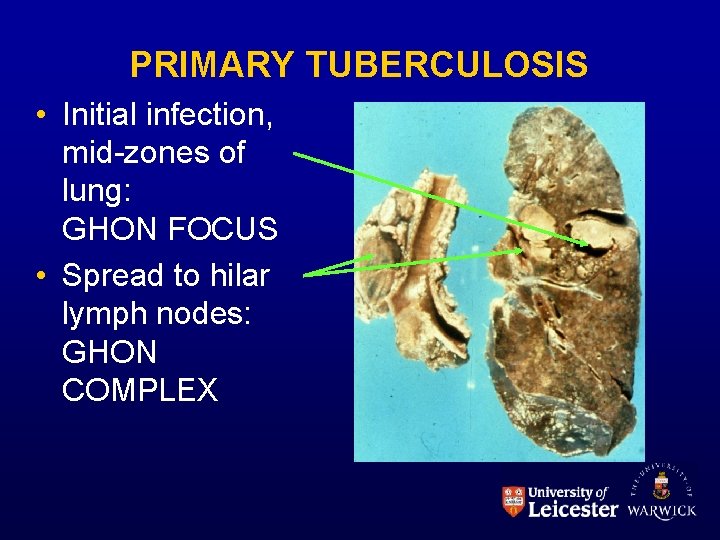 PRIMARY TUBERCULOSIS • Initial infection, mid-zones of lung: GHON FOCUS • Spread to hilar