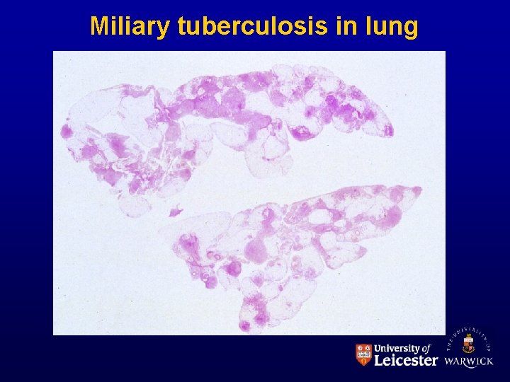 Miliary tuberculosis in lung 