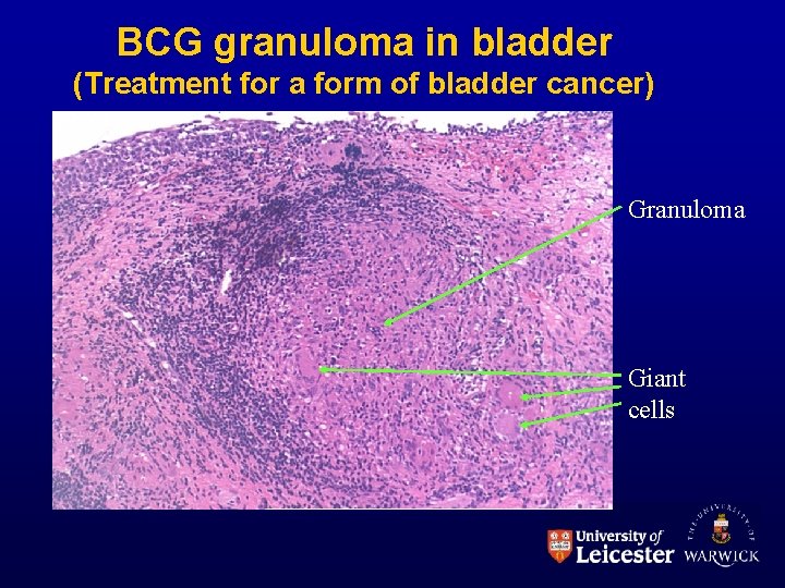 BCG granuloma in bladder (Treatment for a form of bladder cancer) Granuloma Giant cells