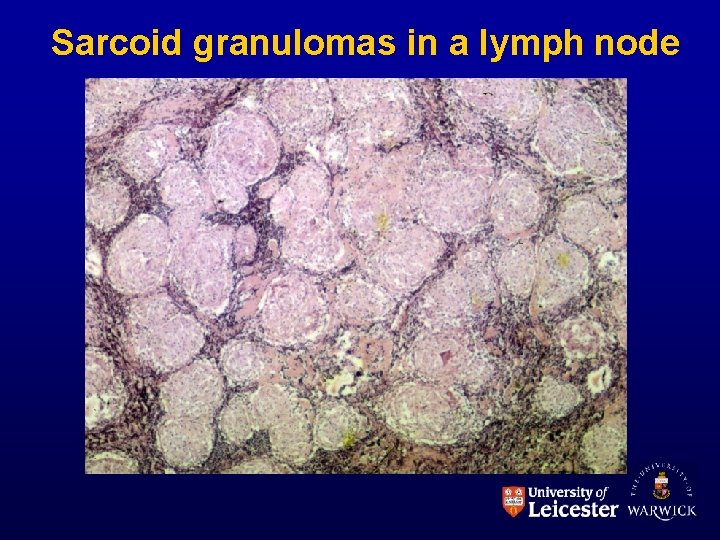 Sarcoid granulomas in a lymph node 