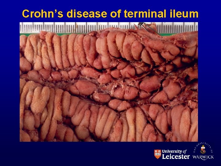 Crohn’s disease of terminal ileum 