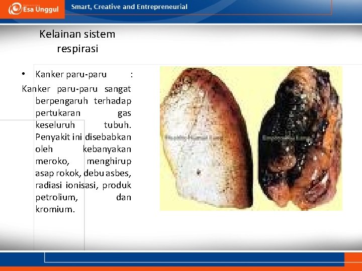Kelainan sistem respirasi • Kanker paru-paru : Kanker paru-paru sangat berpengaruh terhadap pertukaran gas