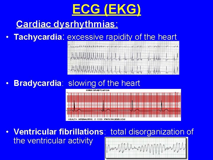ECG (EKG) Cardiac dysrhythmias: • Tachycardia: excessive rapidity of the heart • Bradycardia: slowing ECG (EKG) Cardiac dysrhythmias: • Tachycardia: excessive rapidity of the heart • Bradycardia: slowing