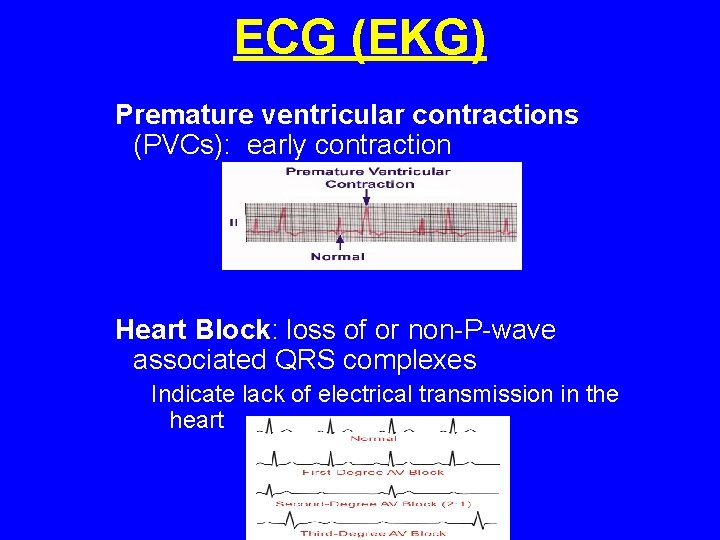 ECG (EKG) Premature ventricular contractions (PVCs): early contraction Heart Block: loss of or non-P-wave ECG (EKG) Premature ventricular contractions (PVCs): early contraction Heart Block: loss of or non-P-wave