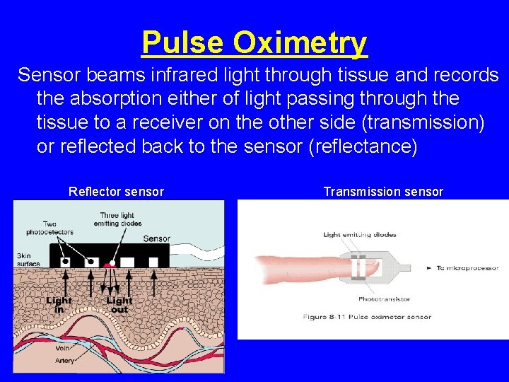 Pulse Oximetry Sensor beams infrared light through tissue and records the absorption either of Pulse Oximetry Sensor beams infrared light through tissue and records the absorption either of