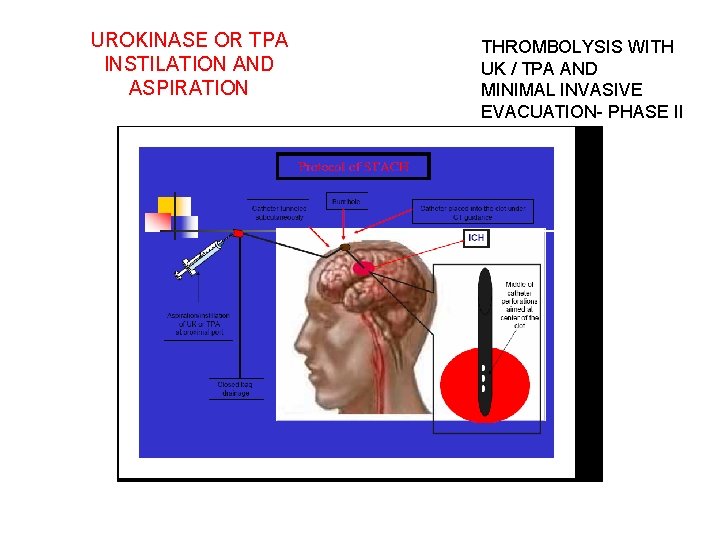 UROKINASE OR TPA INSTILATION AND ASPIRATION THROMBOLYSIS WITH UK / TPA AND MINIMAL INVASIVE