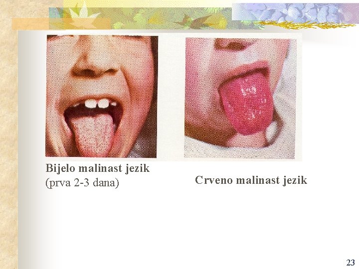 Bijelo malinast jezik (prva 2 -3 dana) Crveno malinast jezik 23 
