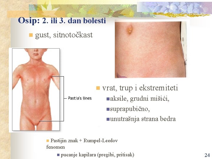 Osip: 2. ili 3. dan bolesti n gust, sitnotočkast n vrat, trup i ekstremiteti