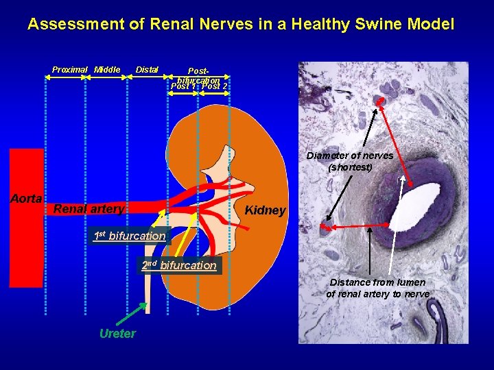 Assessment of Renal Nerves in a Healthy Swine Model Proximal Middle Distal Postbifurcation Post