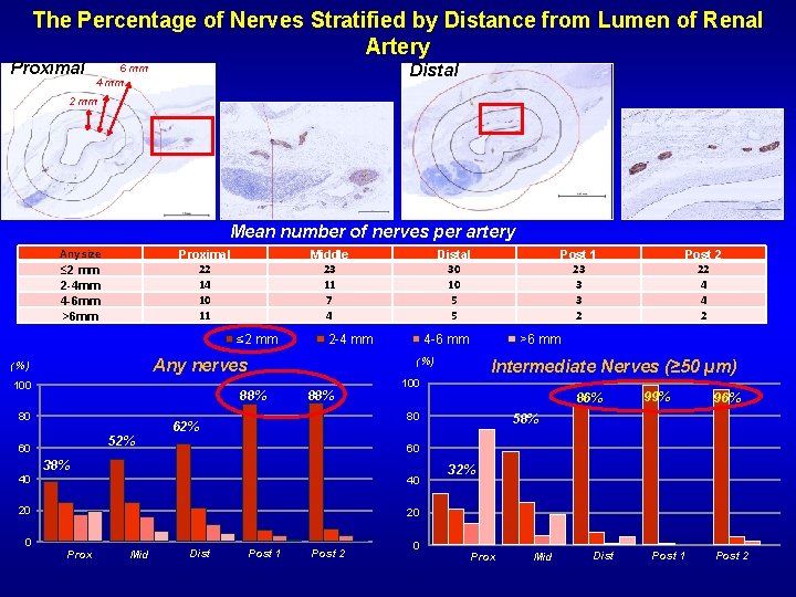 The Percentage of Nerves Stratified by Distance from Lumen of Renal Artery Proximal Distal