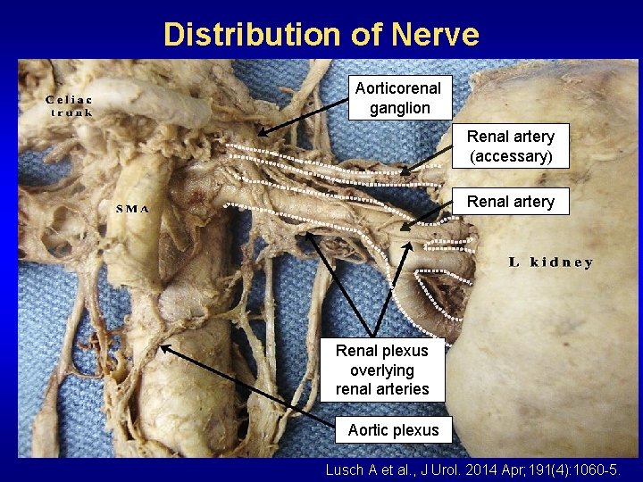 Distribution of Nerve Aorticorenal ganglion Renal artery (accessary) Renal artery Renal plexus overlying renal