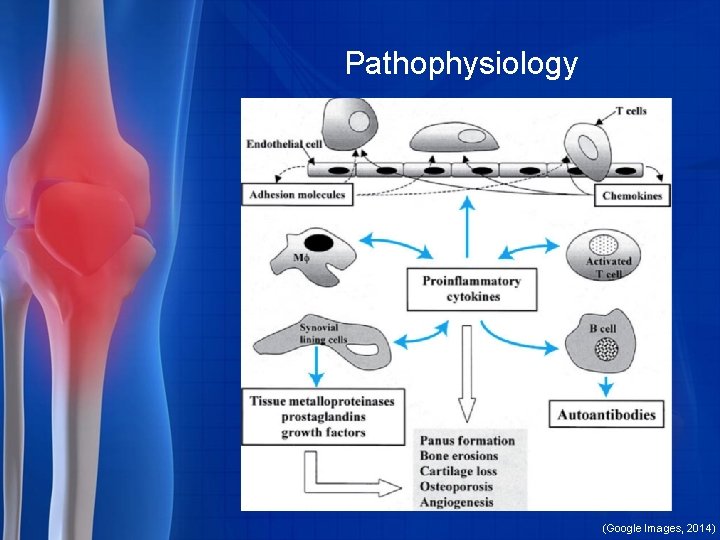 Pathophysiology (Google Images, 2014) 