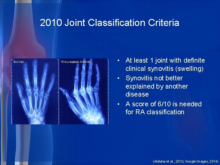 2010 Joint Classification Criteria • At least 1 joint with definite clinical synovitis (swelling)