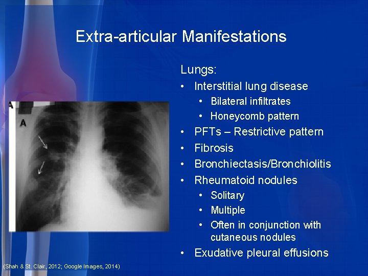 Extra-articular Manifestations Lungs: • Interstitial lung disease • Bilateral infiltrates • Honeycomb pattern •