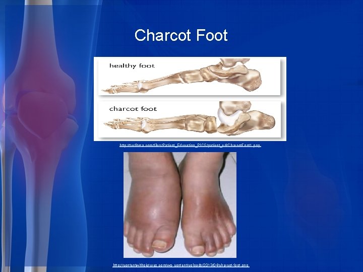 Charcot Foot http: //trufitusa. com/files/Patient_Education_PICS/patient_ed/Charcot. Foot 1. png http: //contentwithpictures. com/wp-content/uploads/2013/04/charcot-foot. png 