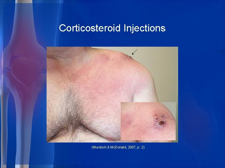 Corticosteroid Injections (Murdoch & Mc. Donald, 2007, p. 2) 