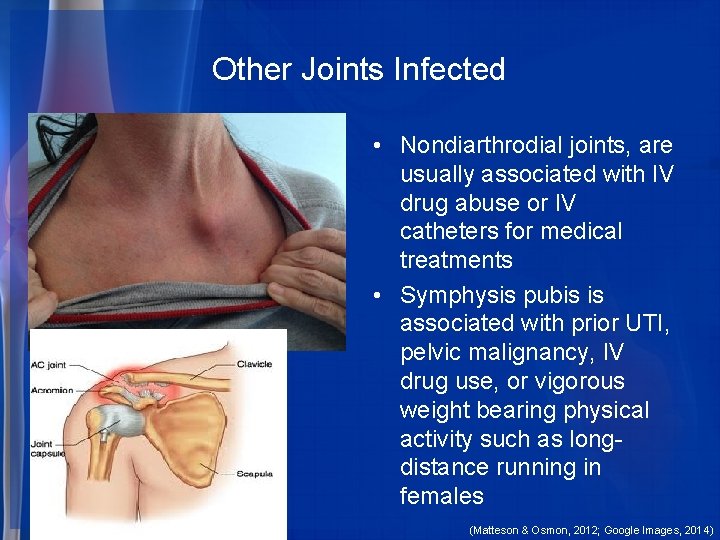 Other Joints Infected • Nondiarthrodial joints, are usually associated with IV drug abuse or