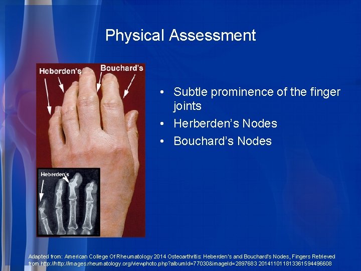 Physical Assessment • Subtle prominence of the finger joints • Herberden’s Nodes • Bouchard’s