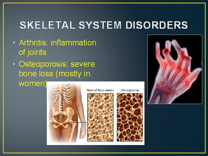 SKELETAL SYSTEM DISORDERS • Arthritis: inflammation of joints • Osteoporosis: severe bone loss (mostly