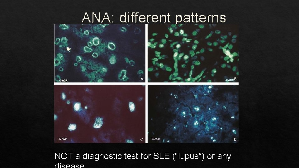 ANA: different patterns NOT a diagnostic test for SLE (“lupus”) or any 