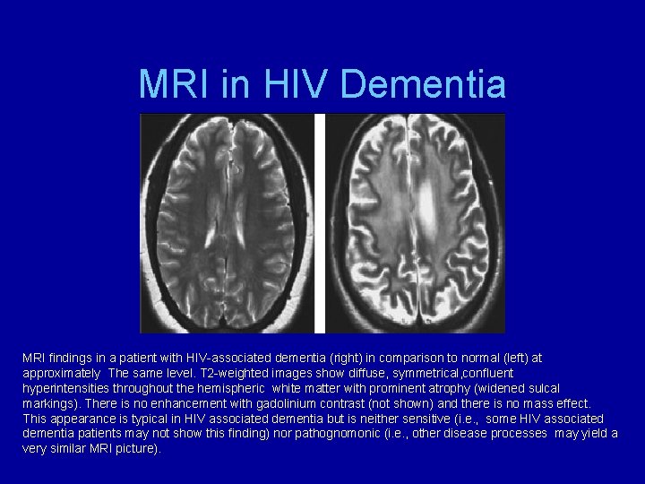 MRI in HIV Dementia MRI findings in a patient with HIV-associated dementia (right) in