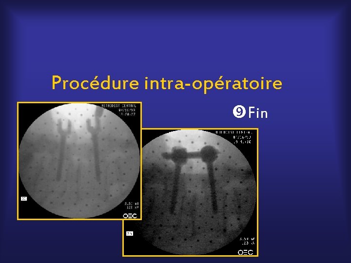Procédure intra-opératoire Fin 