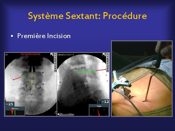 Système Sextant: Procédure • Première Incision 