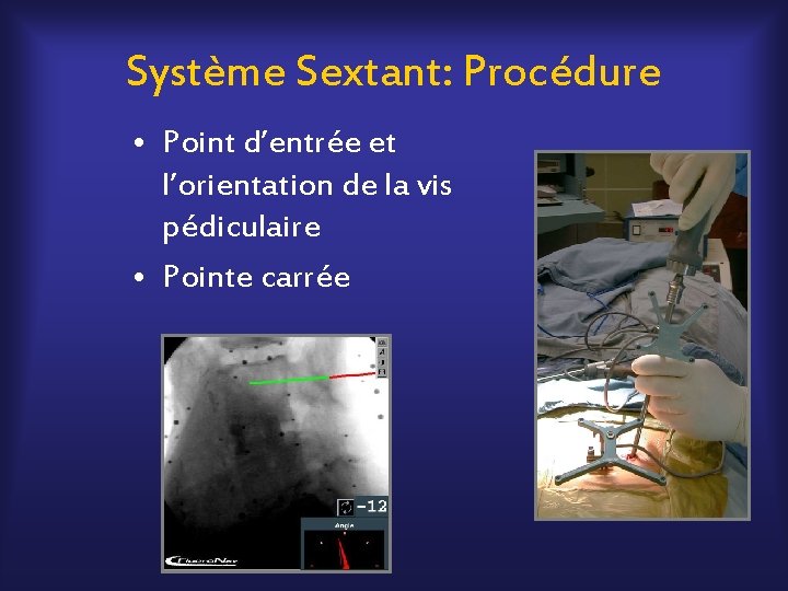 Système Sextant: Procédure • Point d’entrée et l’orientation de la vis pédiculaire • Pointe