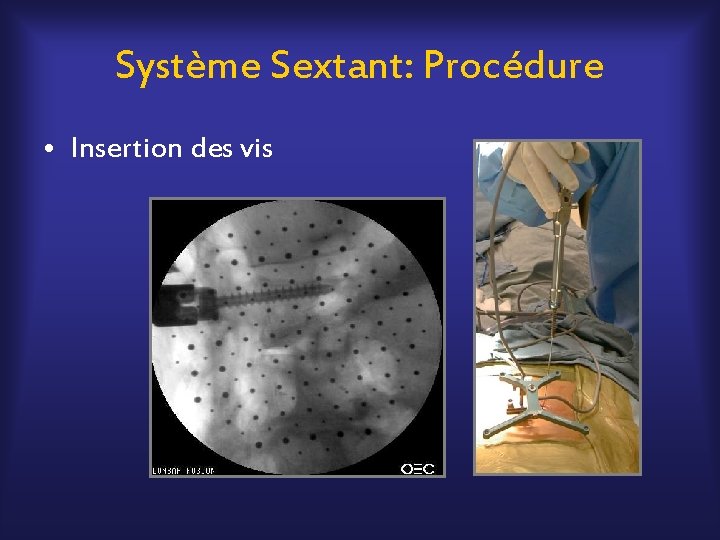 Système Sextant: Procédure • Insertion des vis 