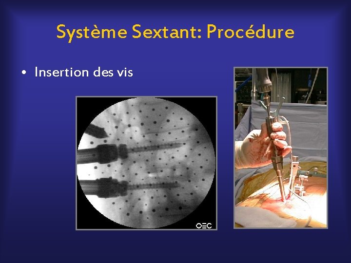 Système Sextant: Procédure • Insertion des vis 