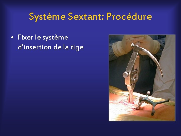 Système Sextant: Procédure • Fixer le système d’insertion de la tige 