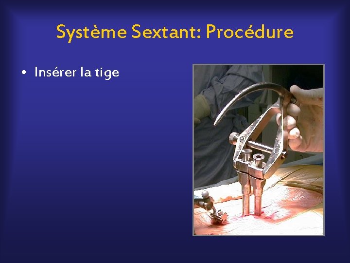 Système Sextant: Procédure • Insérer la tige 