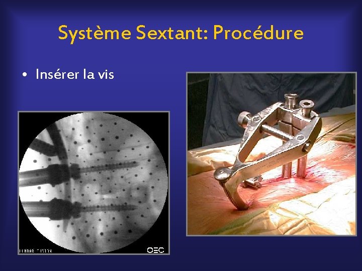 Système Sextant: Procédure • Insérer la vis 