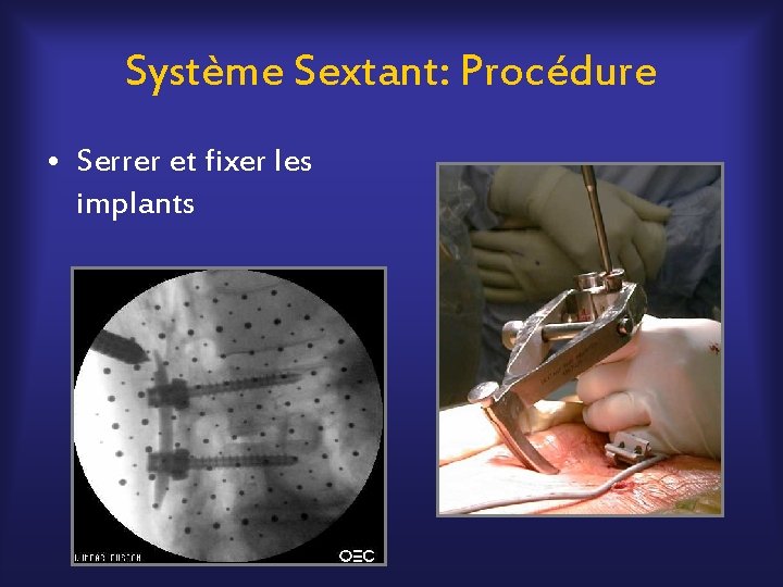 Système Sextant: Procédure • Serrer et fixer les implants 