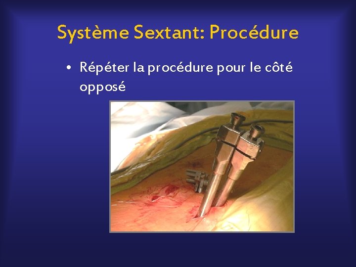 Système Sextant: Procédure • Répéter la procédure pour le côté opposé 