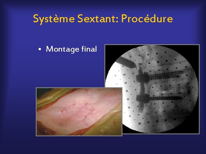 Système Sextant: Procédure • Montage final 