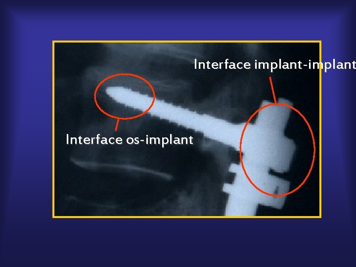 Interface implant-implant Interface os-implant 