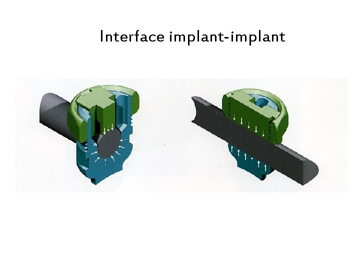 Interface implant-implant 