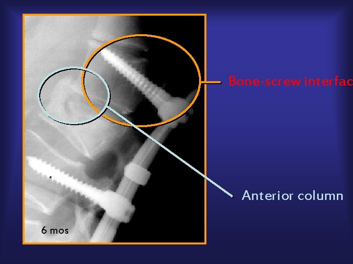 Bone-screw interface Anterior column 6 mos 