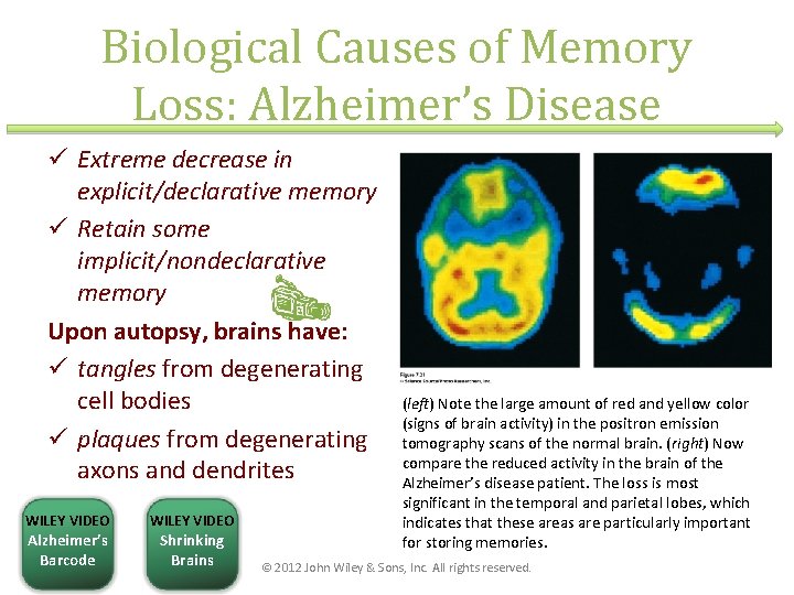 Biological Causes of Memory Loss: Alzheimer’s Disease ü Extreme decrease in explicit/declarative memory ü