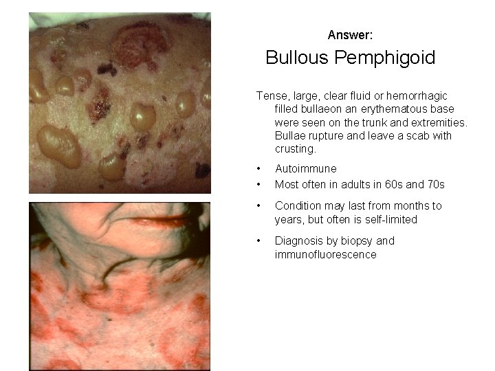 Answer: Bullous Pemphigoid Tense, large, clear fluid or hemorrhagic filled bullaeon an erythematous base