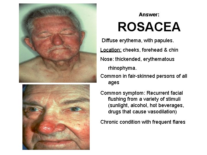 Answer: ROSACEA Diffuse erythema, with papules. Location: cheeks, forehead & chin Nose: thickended, erythematous