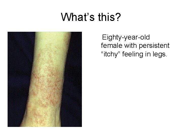 What’s this? Eighty-year-old female with persistent “itchy” feeling in legs. 