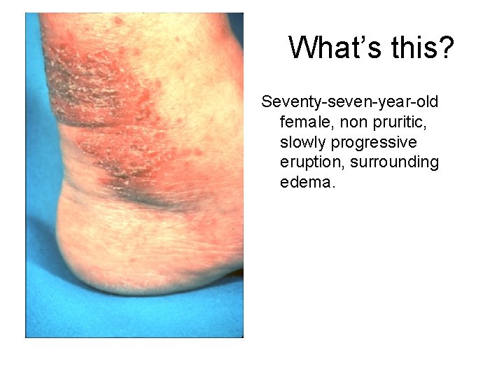 What’s this? Seventy-seven-year-old female, non pruritic, slowly progressive eruption, surrounding edema. 