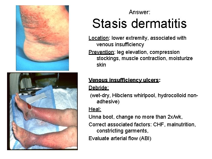 Answer: Stasis dermatitis Location: lower extremity, associated with venous insufficiency Prevention: leg elevation, compression