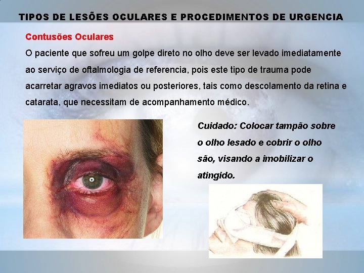 TIPOS DE LESÕES OCULARES E PROCEDIMENTOS DE URGENCIA Contusões Oculares O paciente que sofreu