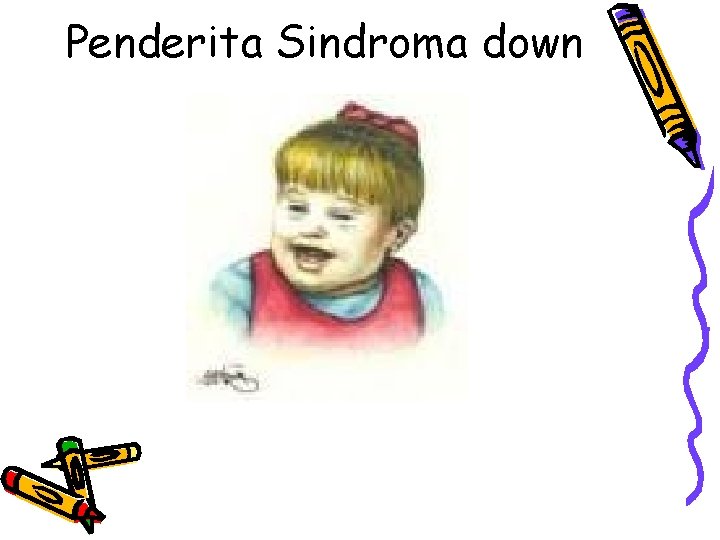 Penderita Sindroma down 