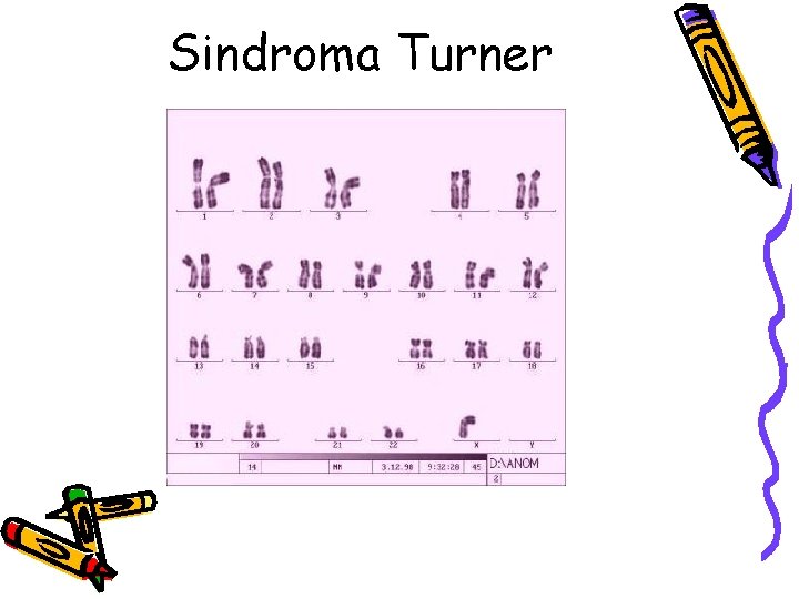 Sindroma Turner 