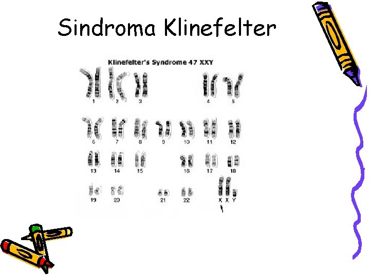 Sindroma Klinefelter 