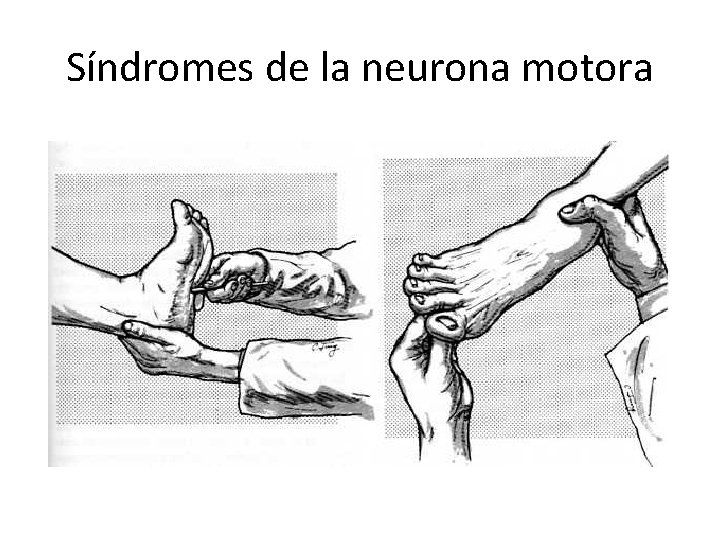 Síndromes de la neurona motora 